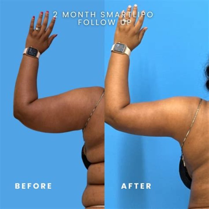 
Blessing CEO: Why I Opened Up About My Liposuction 