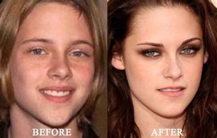 Kristen Stewart Plastic Surgery