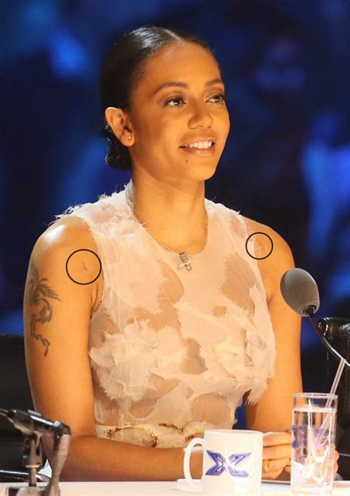 Mel B Bruising Evidence — PICS